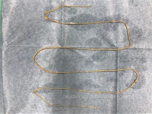 寄生虫事例写真