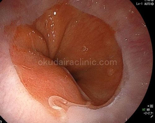 寄生虫事例写真