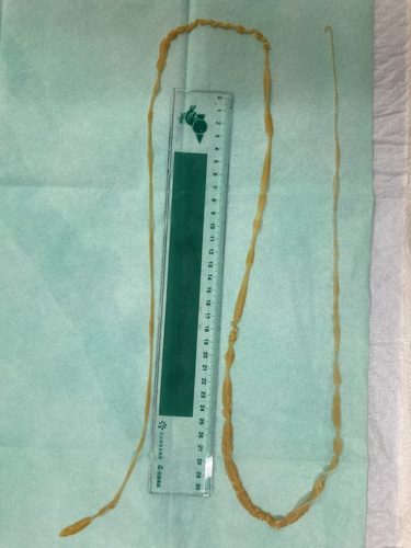 寄生虫事例写真