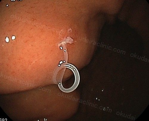 寄生虫事例写真